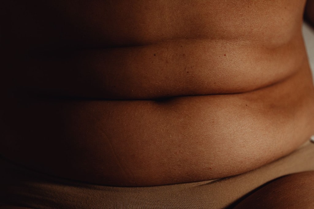 Tummy Tuck